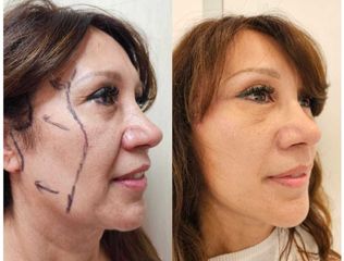 Lifting Facial - Dr. Matias Llabres