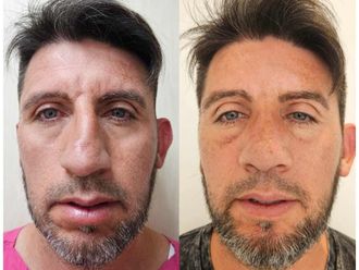 Rinoplastia antes y después - 873930