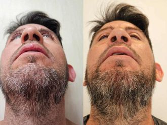 Rinoplastia antes y después - 873934