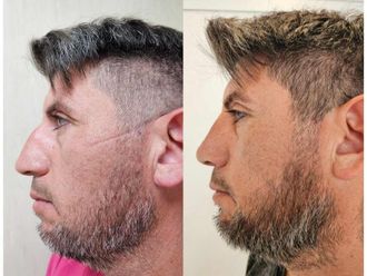 Rinoplastia antes y después - 873935