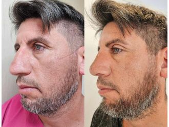 Rinoplastia antes y después - 873936