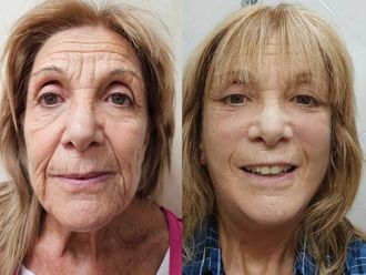 Lifting antes y después - 874406
