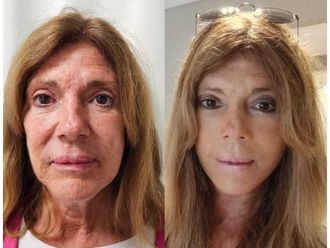 Lifting antes y después - 874527