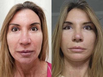 Lifting antes y después - 874528
