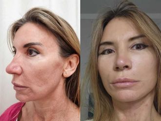 Lifting antes y después - 874529