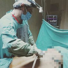 Lipoaspiración - Dr. Alejandro Leone