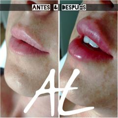 Relleno de labios - Dr. Alejandro Leone