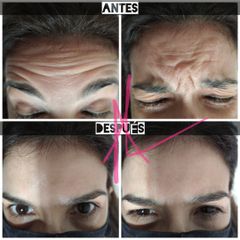 Botox - Dr. Alejandro Leone