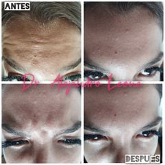 Botox en Frente y Entrecejo - Dr. Alejandro Leone