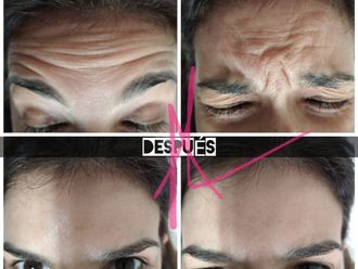 Botox antes y después - 868607