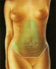 Abdominoplastia