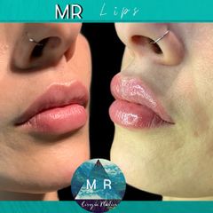 Aumento de labios: MR Lips - Dr. Matias Rodgers