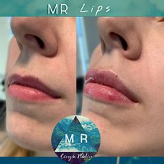 Aumento de labios: MR Lips - Dr. Matias Rodgers