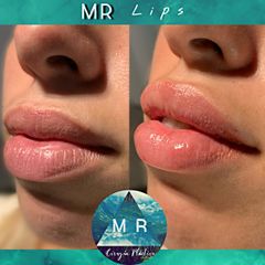 Aumento de labios: MR Lips - Dr. Matias Rodgers