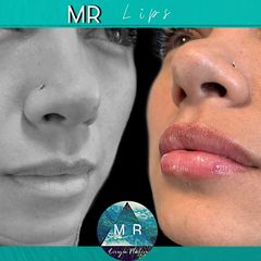 Aumento de labios: MR Lips - Dr. Matias Rodgers