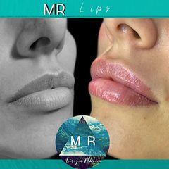 Aumento de labios: MR Lips - Dr. Matias Rodgers