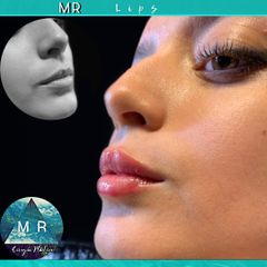 Aumento de labios: MR Lips - Dr. Matias Rodgers