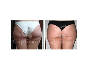 Celulitis