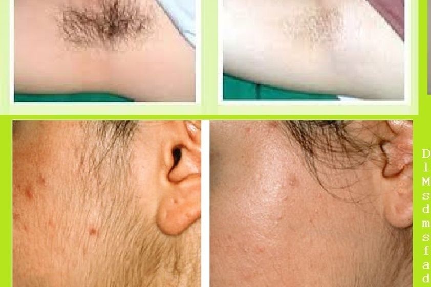 Depilación láser antes y después - 580657