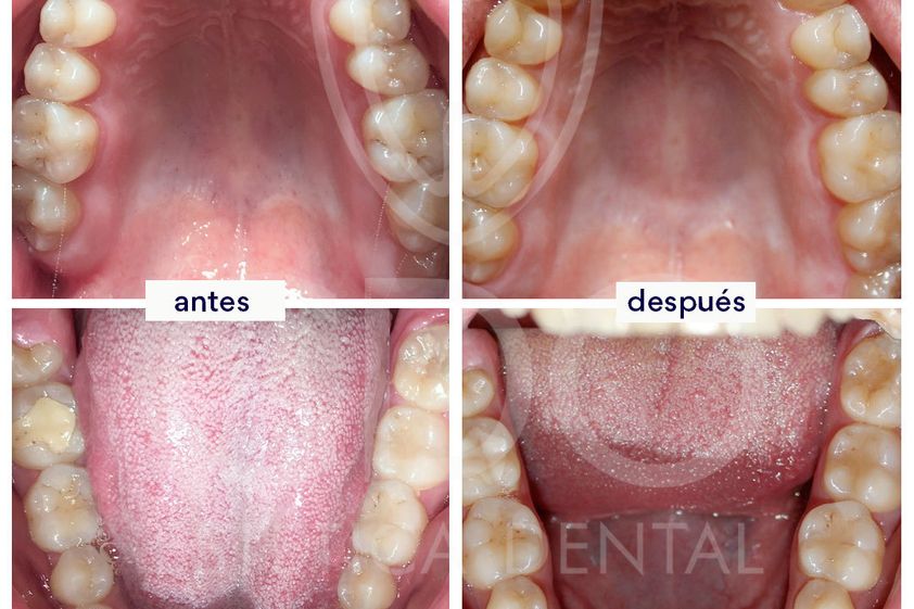 Ortodoncia invisible antes y después - 648431