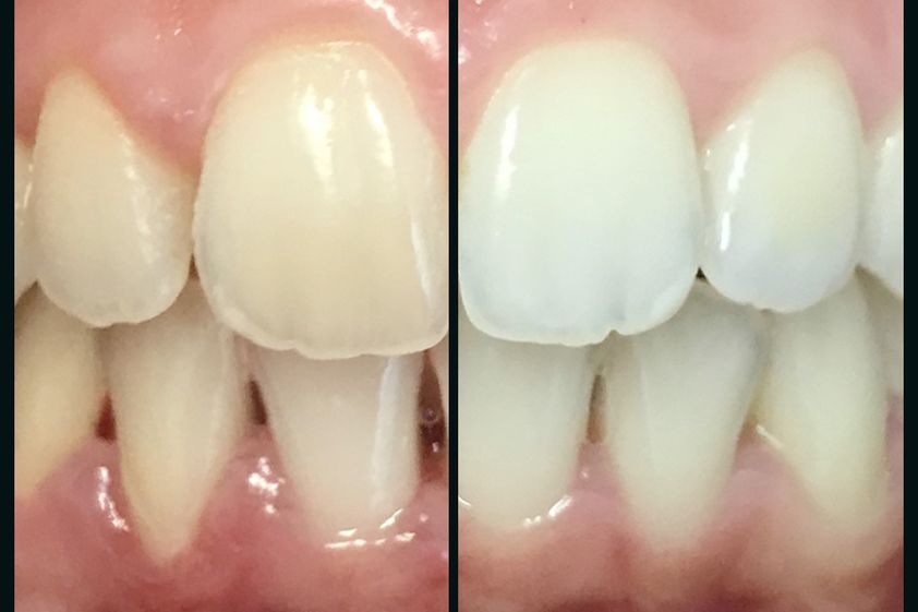 Blanqueamiento dental antes y después - 697108