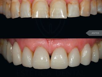 Carillas dentales - 788596