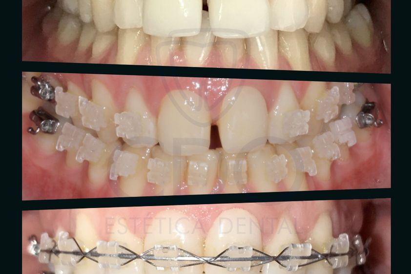 Ortodoncia antes y después - 794212