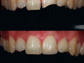 Carillas dentales - 794423