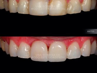 Carillas dentales - 800123