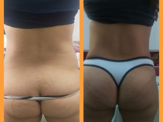 Dermolipectomía - 628520