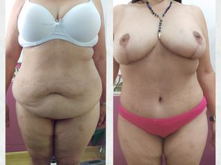 abdominoplastia