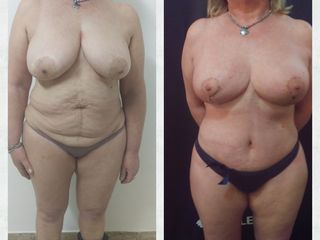 abdominoplasta y reduccion mamaria