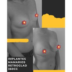 Implantes mamarios 360 cc