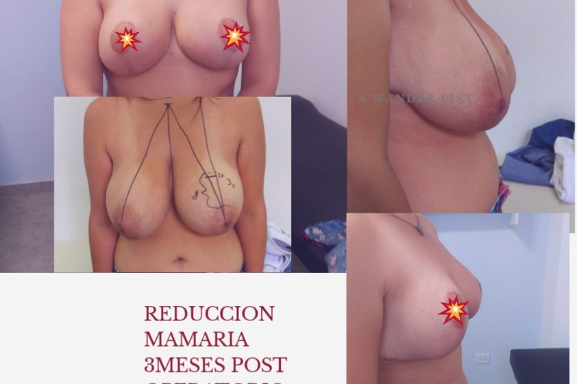 Reconstrucción mamaria antes y después - 688344