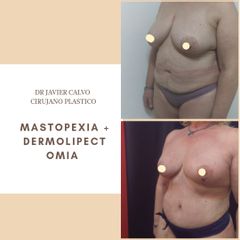Mastopexia + Abdominoplastia 