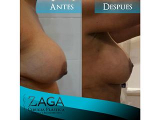 aumento mamario 1- dr. zambrano
