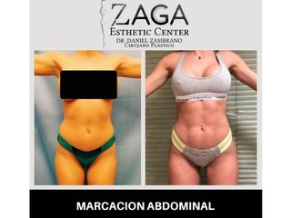 marcacion abdominal