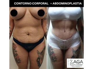 contorno corporal + abdominoplastia