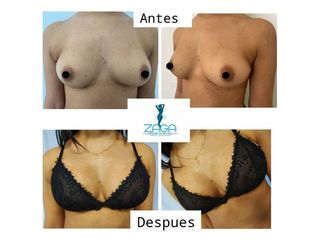 Aumento mamas - Dr. Daniel Zambrano
