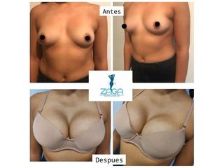 Aumento mamas - Dr. Daniel Zambrano
