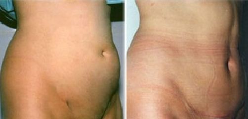 Abdominoplastia