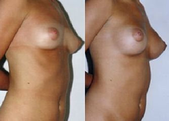 Mamoplastia