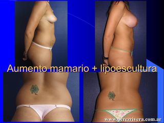 Mamas + lipoescultura