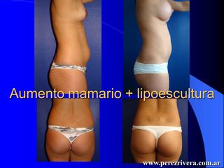 Mamas + lipoescultura