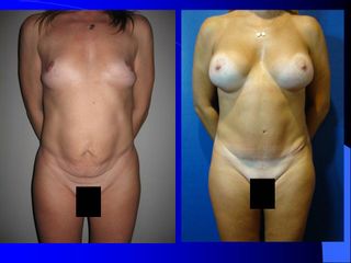 Mamas + abdominoplastía