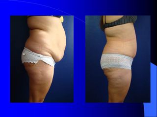 Dermolipectomía + lipo