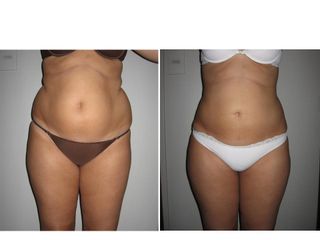 Lipoescultura