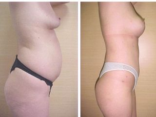 Aumento mamario y abdominoplastia