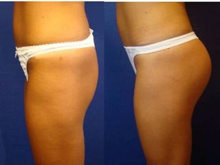 Gluteoplastia protésica