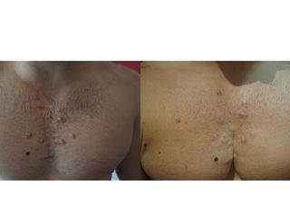 queloide
